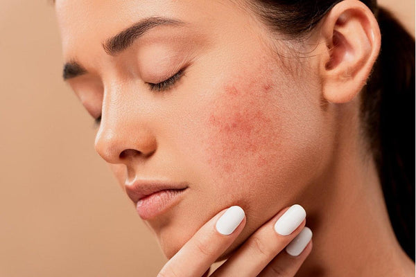 6 Sneaky Reasons You Get Acne - Clean Face Company